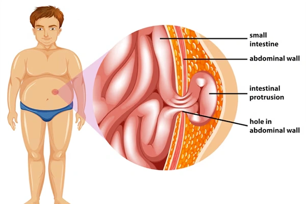 Complex Hernia repair and AWR ETEP
