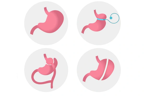 Bariatric procedures