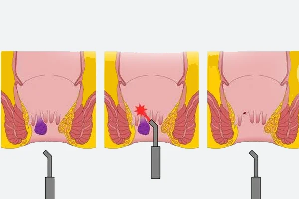 Laser Treatment for Piles