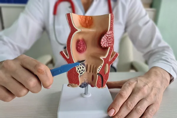 Laser Treatment for Fistula