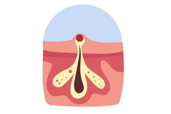 Laser Treatment for Pilonidal Sinus