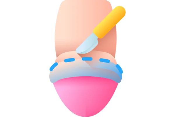 Circumcision